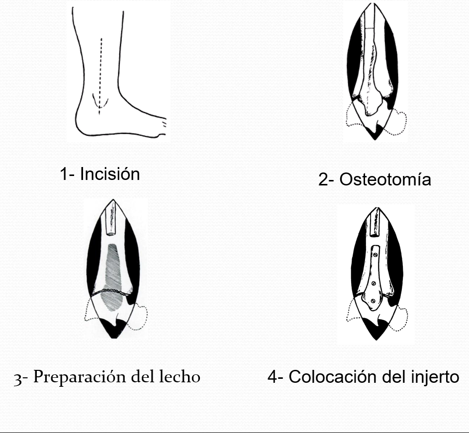 Técnica de Artrodesis Transperónea de JC Adams