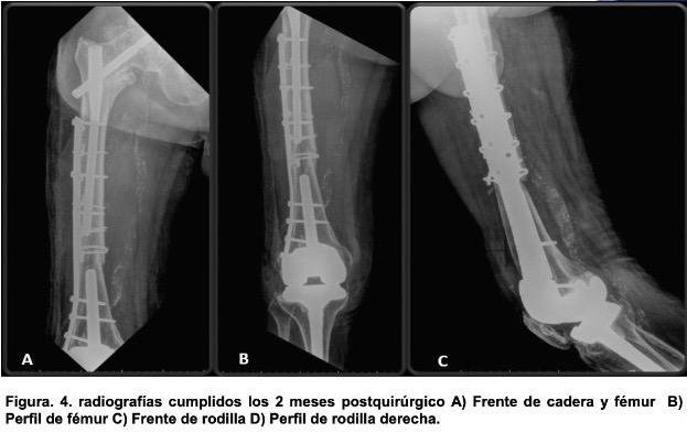 Figura. 4. radiografías cumplidos los 2 meses postquirúrgico A) Frente de cadera y fémur  B) Perfil de fémur C) Frente de rodilla D) Perfil de rodilla derecha.