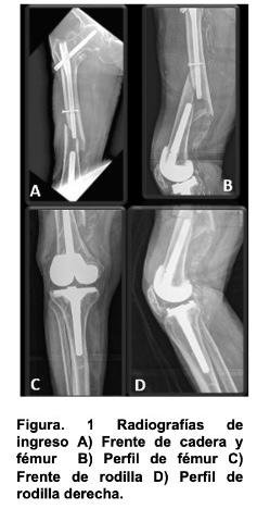 Figura. 1 Radiografías de ingreso A) Frente de cadera y fémur derecho.  B) Perfil de fémur derecho.  C) Frente de rodilla derecha.   D) Perfil de rodilla derecha